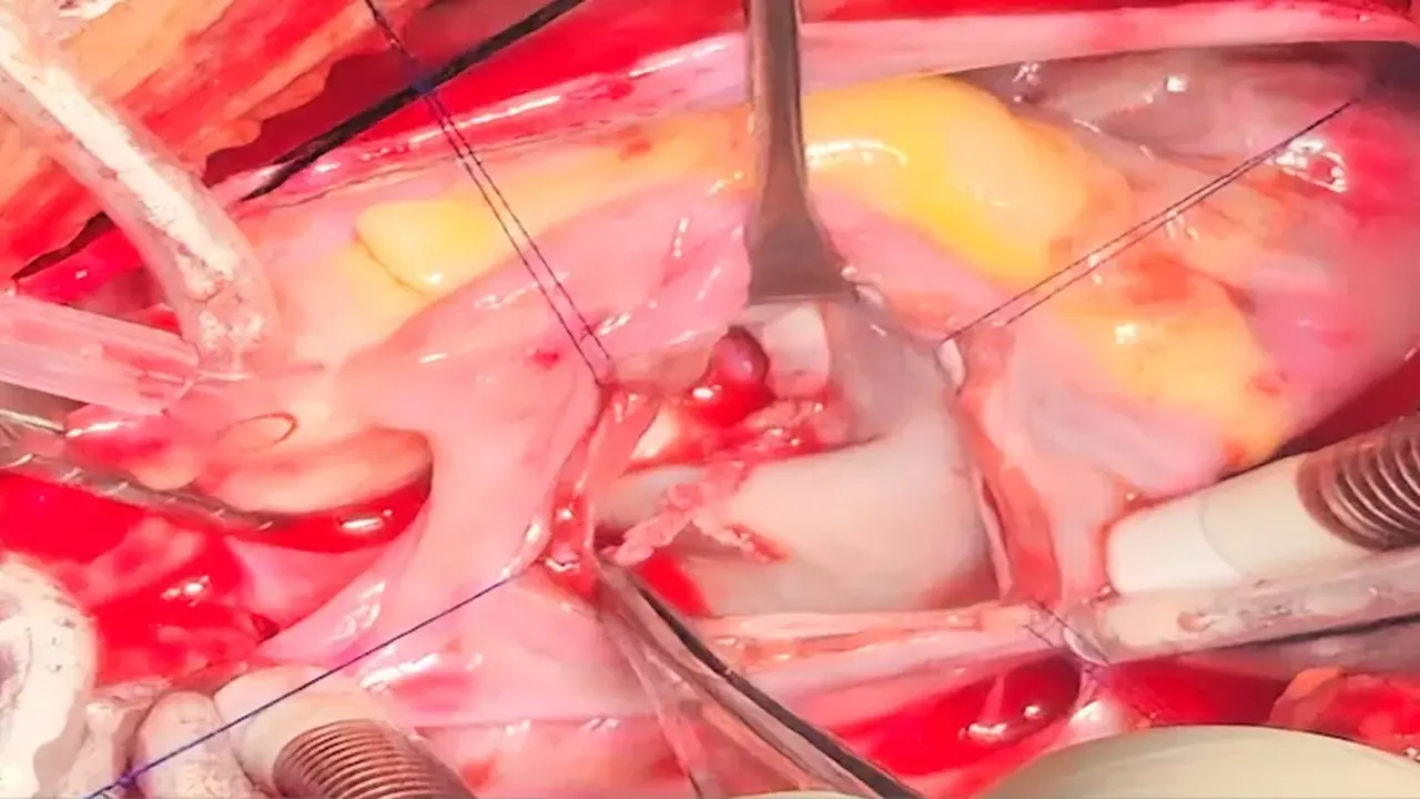 جراحو قصر العيني ينجحون في استئصال ورم قلب طفل دون مساس بالصمام